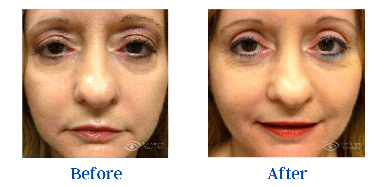 Oculoplastic Surgery Before And After Gallery - Eye Surgery Associates