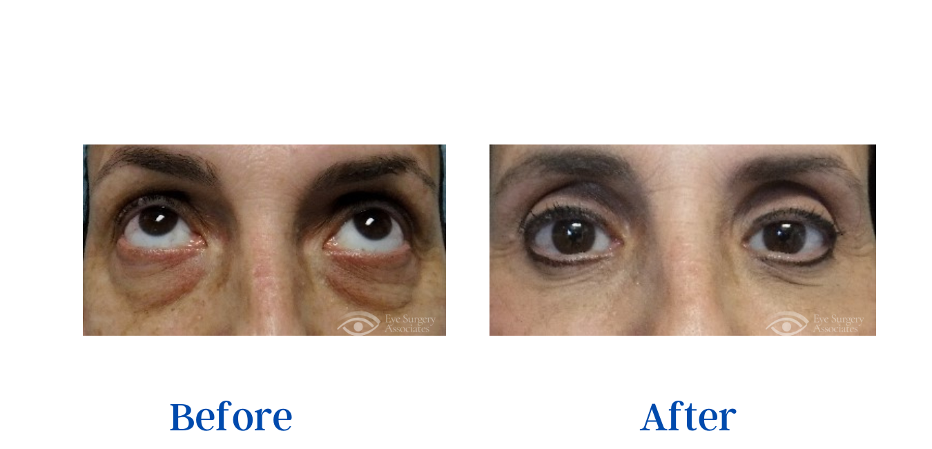 Oculoplastic Surgery Before And After Gallery - Eye Surgery Associates