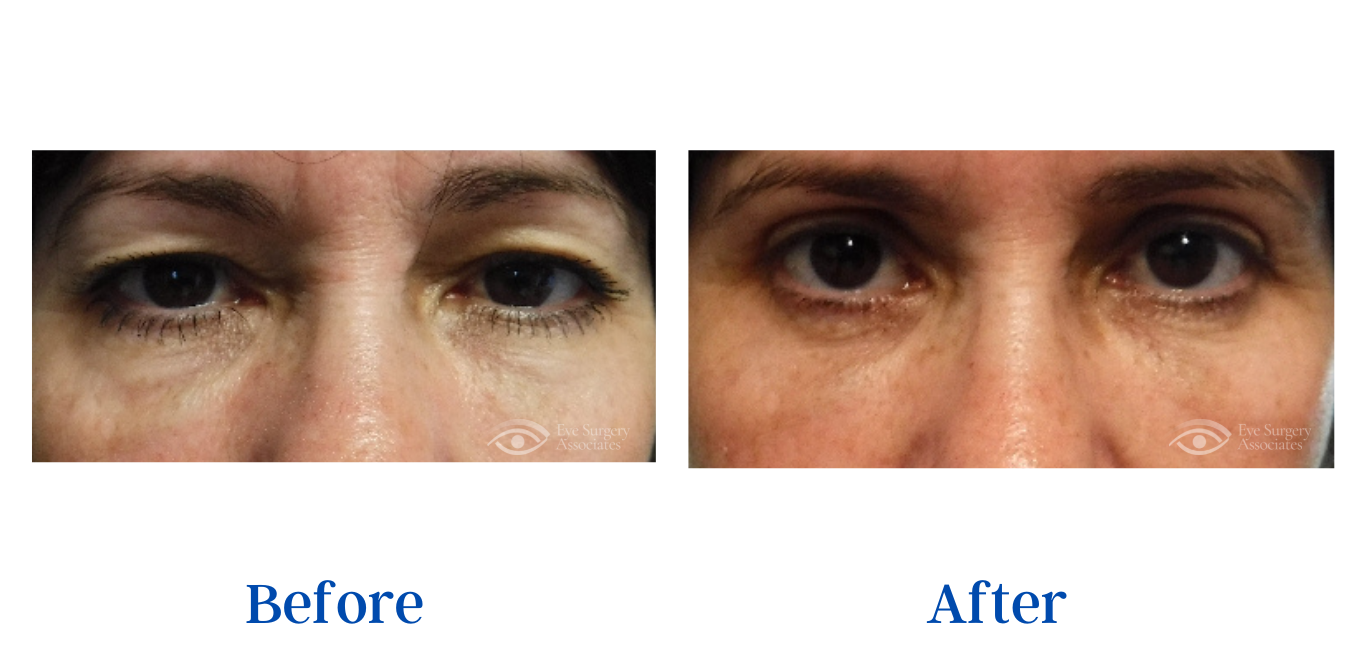 Oculoplastic Surgery Before And After Gallery - Eye Surgery Associates