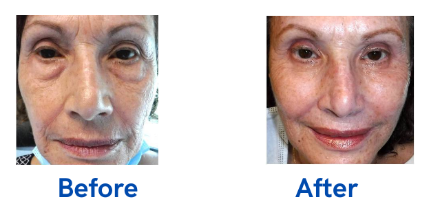 Oculoplastic Surgery Before and After Gallery - Eye Surgery Associates