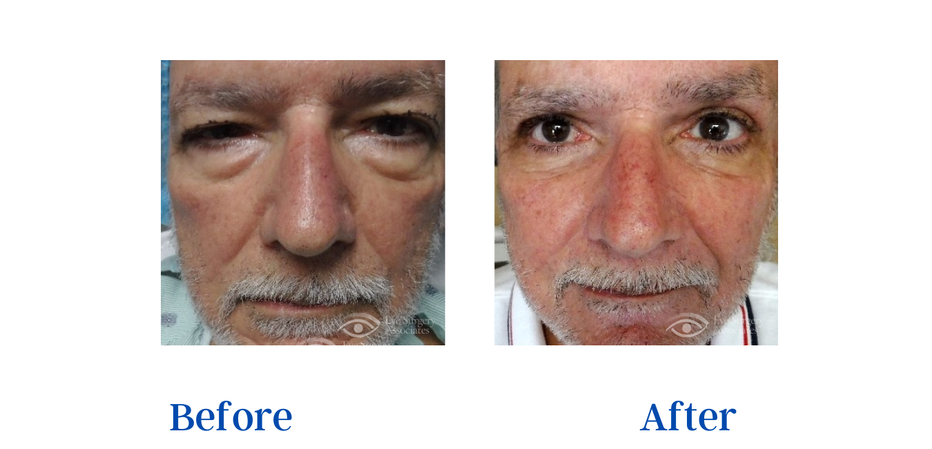 Oculoplastic Surgery Before and After Gallery - Eye Surgery Associates