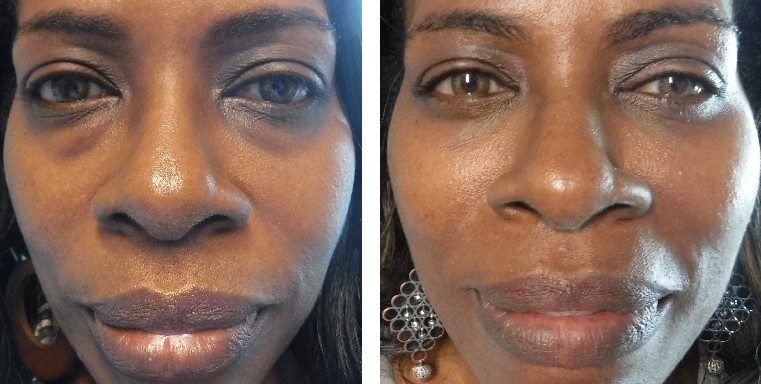 before and after photo of woman who received lower lid blepharoplasty