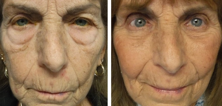 before and after photo of woman with ptosis surgery and blepharoplasty